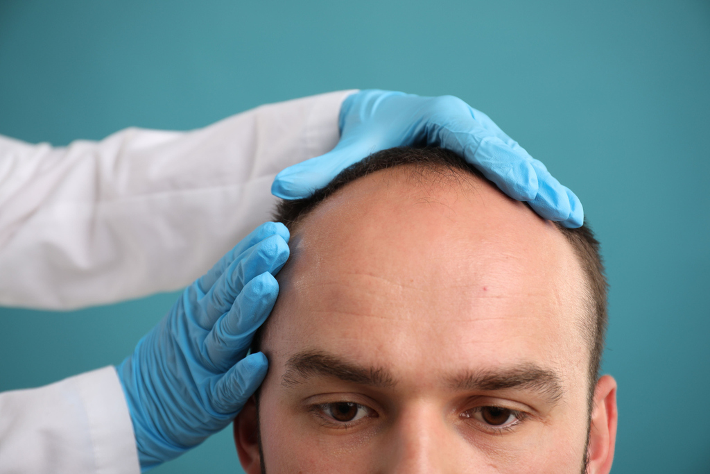 custom Movie Hair non-surgical hair system Free consultation Toronto